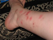 Kill Bed Bugs in Silver Spring/ Kill Bed Bugs Silver Spring, Maryland